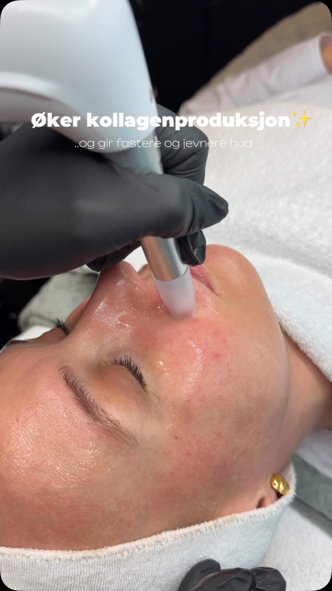 💫Microneedling med XcellarisPro Twist + ledlys -20% hele Oktober 🤩 Microneedling er en avansert ansiktsbehandling med …