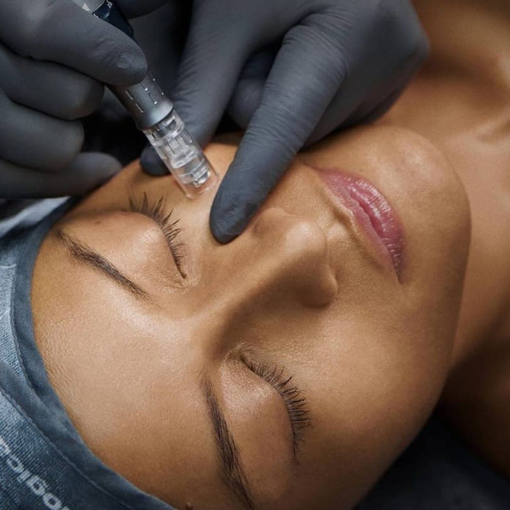 Microneedling utført med håndholdt apparat.